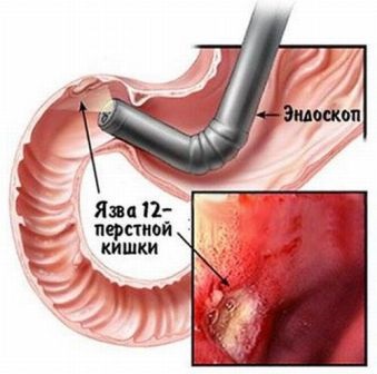 Ulcer perforat, medicament, mai mult decât periculos medicale sibiene