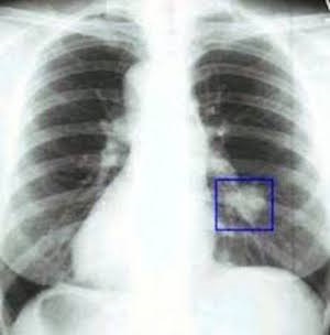 Cancerul pulmonar - simptome, diagnostic și tratament