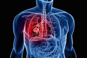 Cancerul pulmonar - simptome, diagnostic și tratament