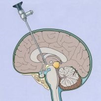 Manipularea vaselor cerebrale cu hidrocefalie