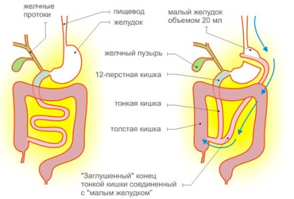 Stingerea stomacului