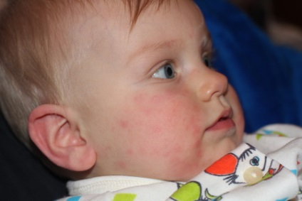 O erupție cutanată pe fața unui nou-născut provoacă erupții la copil