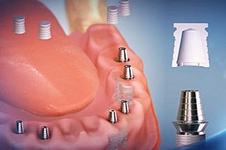 implantációs rendszer a b fogászati ​​és előnyei a fajta