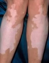 Modalități de utilizare a chiminei de la vitiligo și recenzii ale bolnavilor