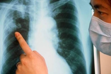 Simptomele și cauzele tuberculozei bronhice
