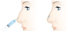Injecțiile diprospanului după rinoplastie - recenzii, rinoplastia nasului