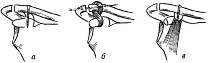 Dislocări ale sfârșitului acromial al simptomelor claviculului, traumatologie sportivă