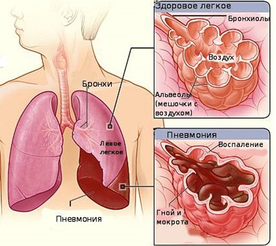 Inflamația plămânilor (pneumonie) - simptome și semne de inflamație