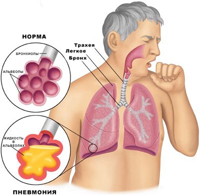 Inflamația plămânilor (pneumonie) - simptome și semne de inflamație