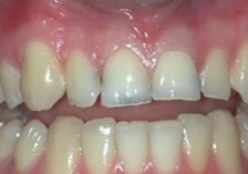 Restaurarea dinților cu eliminarea materialelor compozite
