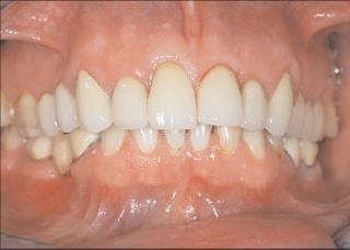 Restaurarea dinților cu eliminarea materialelor compozite