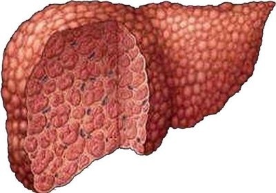 Este posibil să se vindece ciroza hepatică?