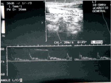 Posibilitățile de diagnostic cu ultrasunete în sindromul arterei vertebrale sunt fundamentale