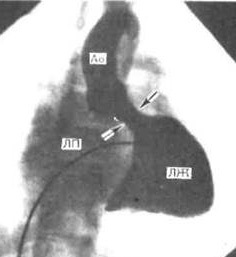 Boala cardiacă congenitală la copii și nou-născuți - cauze, tratament - Portalul Medical Siberian