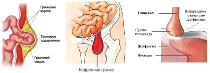 Totul despre semnele și simptomele herniei, metodele de tratament și prevenirea bolilor