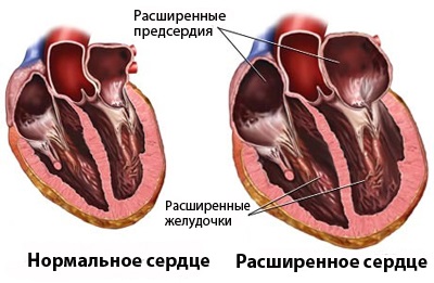 Cardiomiopatia secundară este cauza morții - tratamentul inimii