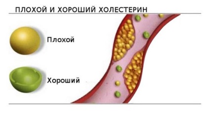 Colesterolul și diabetul zaharat, concepte, riscuri pentru pacient