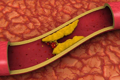 Colesterolul și diabetul zaharat, concepte, riscuri pentru pacient