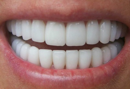 De ce este necesară restaurarea estetică a dinților