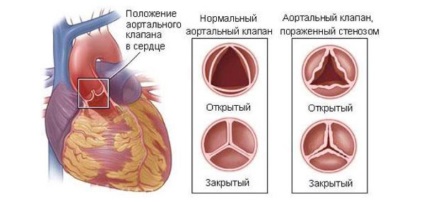 Înlocuirea supapei în centrul vieții după operație, cost și reabilitare