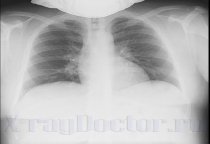 7 X-ray chest cu descrieri