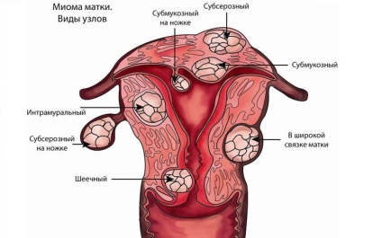 9 Mituri despre miomul uterului