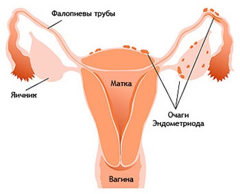 Adenomioza uterului (focală, difuză) în combinație cu miomul uterin