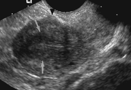 Adenomioza uterului (focală, difuză) în combinație cu miomul uterin