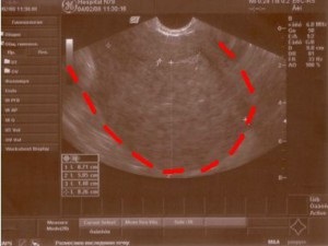 Adenomioza uterului - simptome, diagnostic, tratament, probleme de infertilitate și metode de sex masculin și feminin