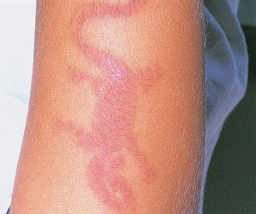 Alergiile dermatitei de contact alergice și tratamentul