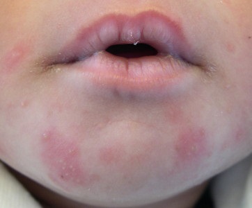 Alergiile dermatitei de contact alergice și tratamentul