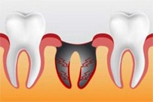 Alveolita - cauze, simptome, complicații și tratamentul alveolitei