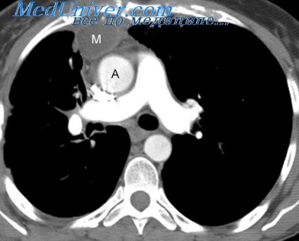 angioszarkóma A mediastinum