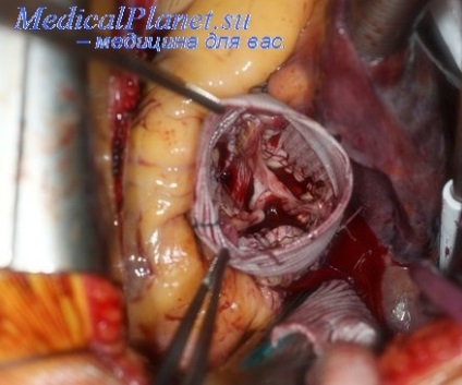 Anticoagulante în infarctul miocardic - tratament cardiac