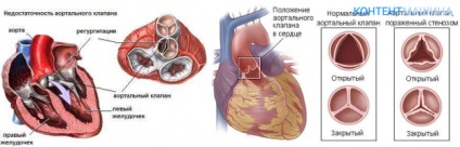 Aortic malformația inimii și cum să o tratezi