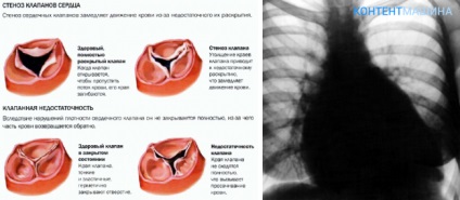 Aortic malformația inimii și cum să o tratezi