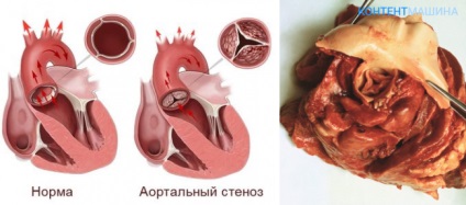 Aortic malformația inimii și cum să o tratezi