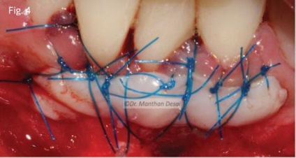 Augmentarea gingiei keratinizate - parodontologie - știri și articole despre stomatologie -