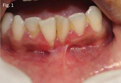 Augmentarea gingiei keratinizate - parodontologie - știri și articole despre stomatologie -