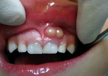 Pată albă pe gingii doare - principalele cauze și tratament
