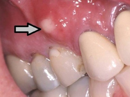 Pată albă pe gingii doare - principalele cauze și tratament