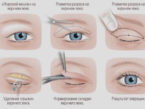 Blefaroplastia transconjunctivală fără fir a pleoapelor inferioare și superioare cu ajutorul unui laser