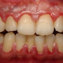 Boli ale gingiilor și ale dinților, fotografie, tratament, simptome