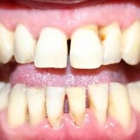 Boli ale gingiilor și ale dinților, fotografie, tratament, simptome