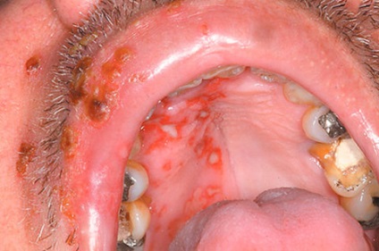 Boli ale cavității orale la adulți - cele mai comune forme și caracteristici ale imaginii clinice