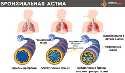 Astmul bronșic al simptomelor de tip alergic, tratamentul și prevenirea bolilor, recomandări 1001