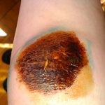 Ce trebuie făcut dacă abraziunea pe genunchi nu se vindecă
