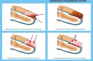 Ce trebuie să faceți dacă picioarele se umflă cu 10 căi pentru a scăpa de edem