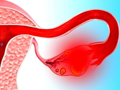Ce este apoplexia ovariană, simptomele și tratamentul