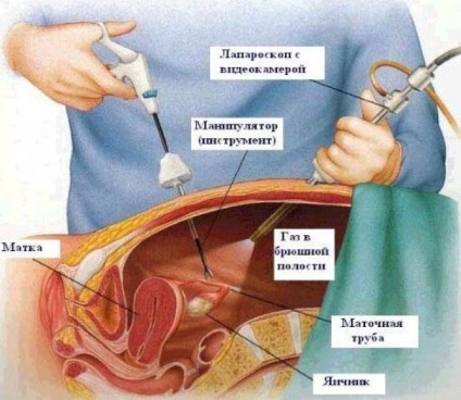 Ce este laparoscopia ovarelor și la care este prezentată